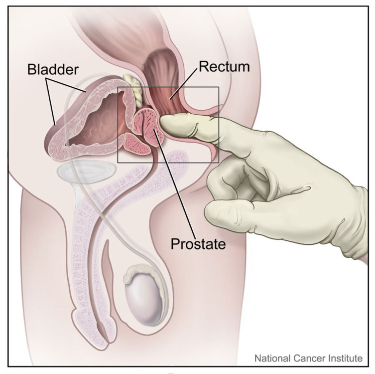 Digital_rectal_exam_(male)